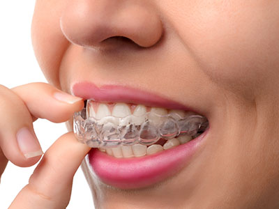 The image shows a person holding their finger near their mouth, with an Invisalign aligner visible on the teeth.
