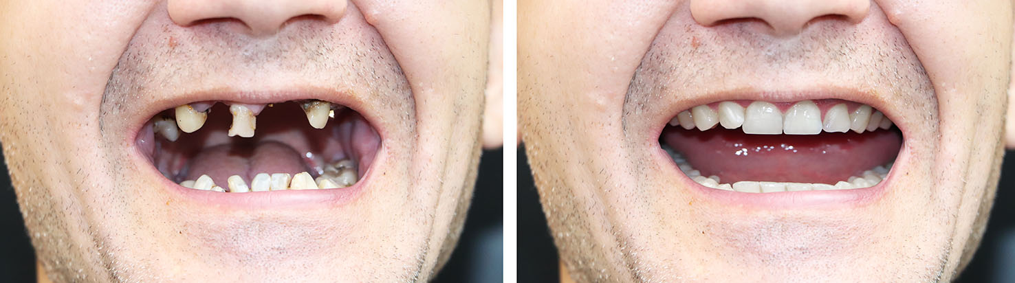 The image shows a person with two different teeth arrangements one side has a full set of teeth while the other appears to be missing several teeth, with a humorous effect created by digitally manipulating the photo.