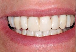 The image shows a close-up of a person s smiling face with a focus on their teeth, which appear to be well-maintained and possibly professionally whitened.