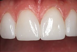 The image shows a close-up of a person s teeth with a focus on dental care, specifically highlighting the importance of regular brushing and cleanliness for maintaining oral health.