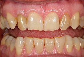 The image shows two photographs side by side of a person s teeth with a focus on dental decay and discoloration, one showing a close-up view of a single tooth and the other displaying a full set of teeth in an open mouth.