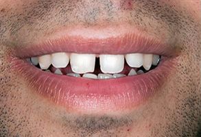 The image shows a person with teeth, smiling broadly at the camera.