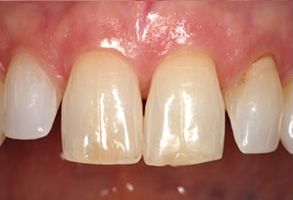 An image showcasing a person s teeth with yellow staining and a pinkish tongue, set against a background that appears to be an interior space.