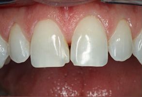 The image shows a close-up view of human teeth with a focus on dental veneers, which are applied to the upper front teeth, enhancing their appearance by improving color and shape.