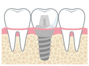 dental implants